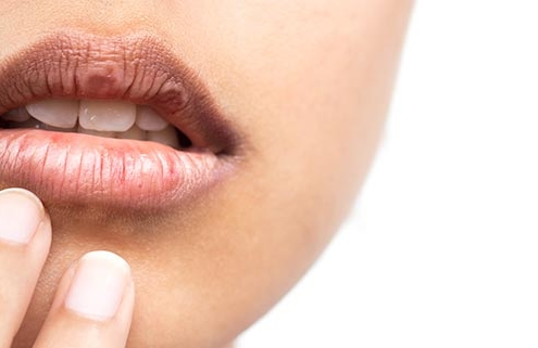 Dry Mouth