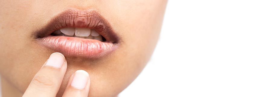 Dry Mouth
