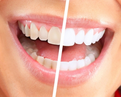 Professional dental cleaning and checkup at Mellow Family Dental Care in Maple Ridge.