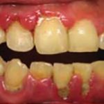 Periodontal Disease - Mellow Family Dental Care