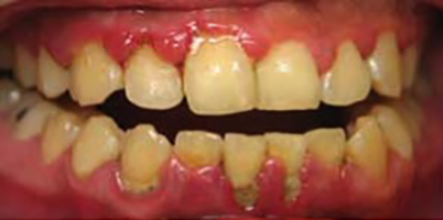 Periodontal Disease - Mellow Family Dental Care