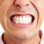 Bruxism