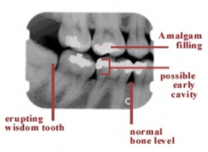 Xray